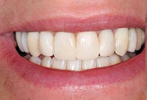 Innovative Dental | Implant Restorations, Teeth Whitening and Emergency Treatment